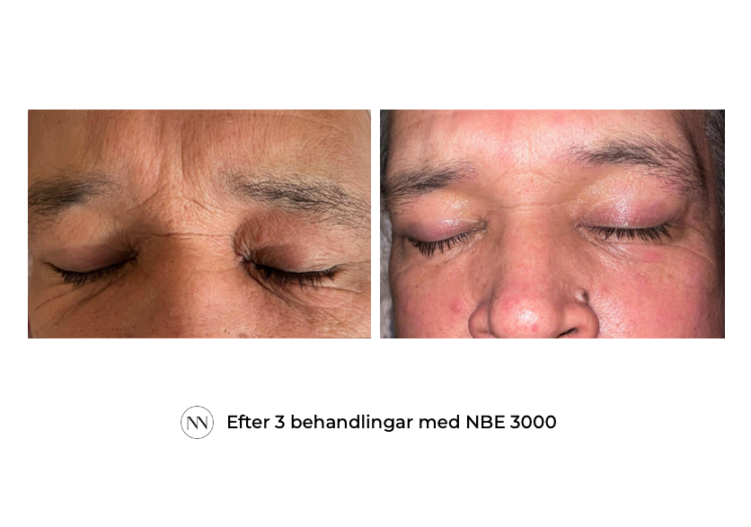 Eyes_2 3x NBE SE