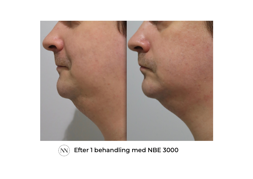 Face_1 1x NBE SE