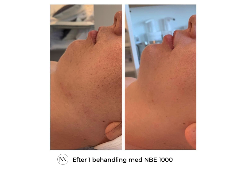 Face_2 1x NBE SE