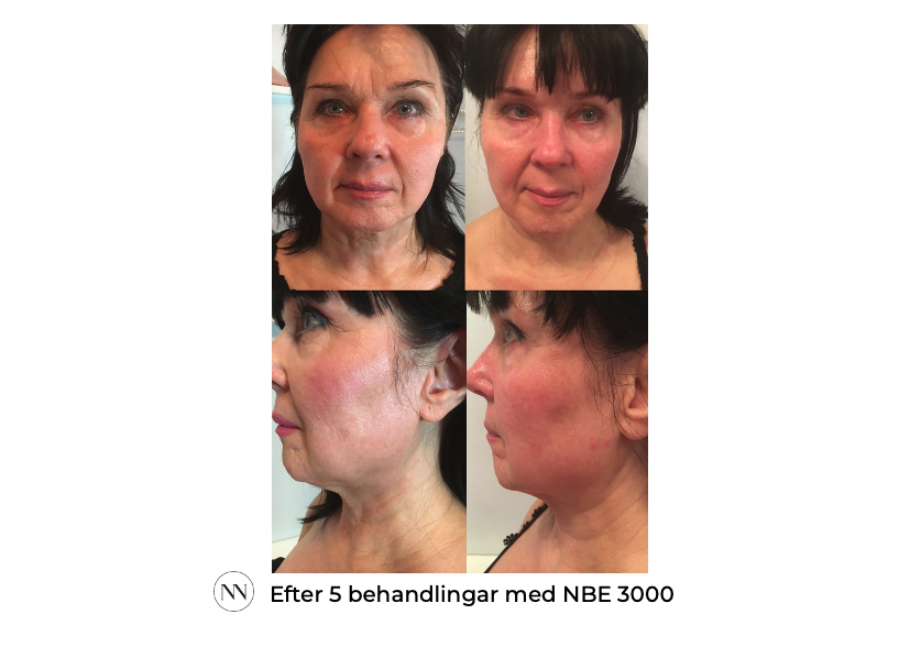 Face_2 5x NBE SE