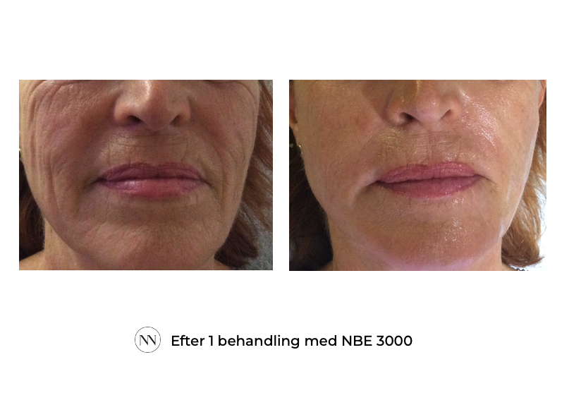 Face_3 1x NBE SE