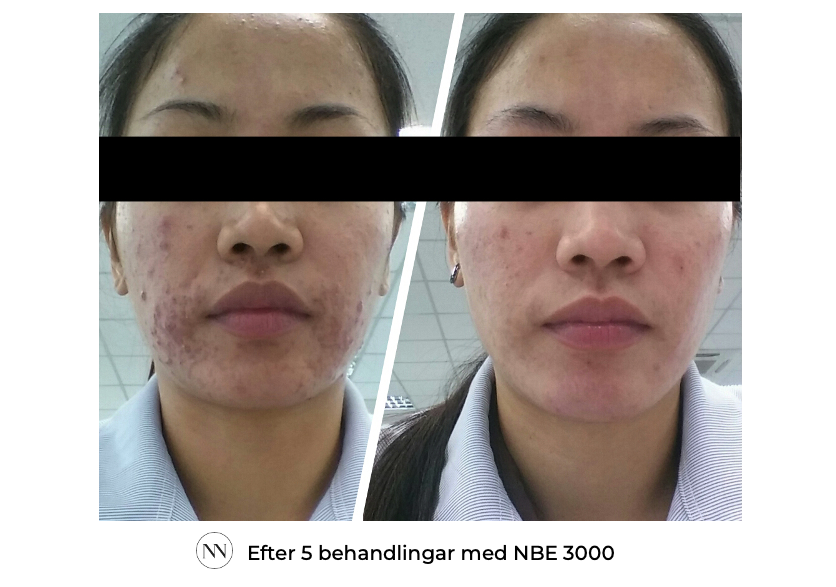 Face_3 5x NBE SE