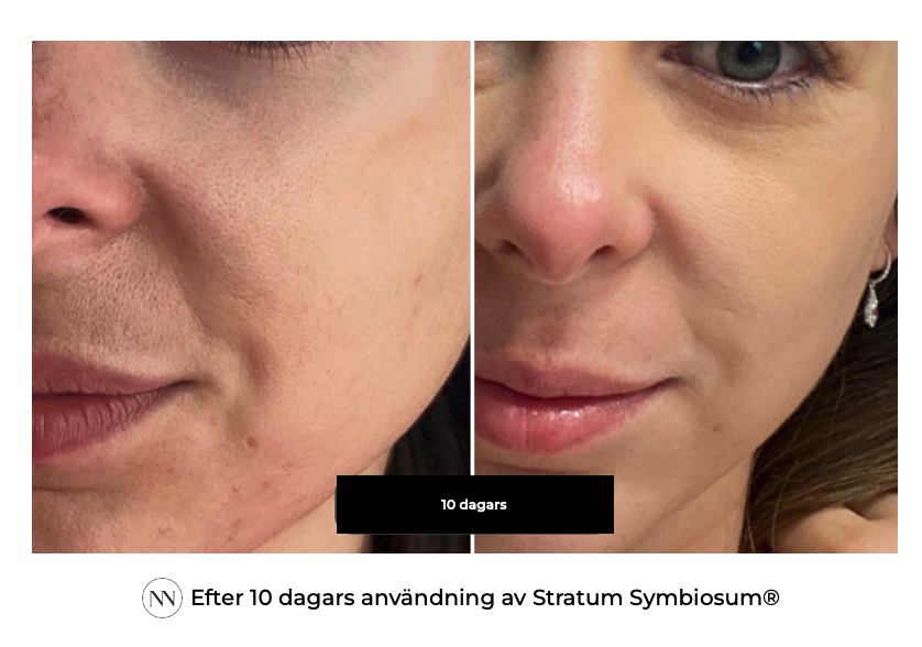 Stratum 10 dagen SE