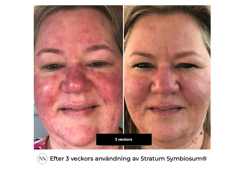 Stratum 3 weeks SE