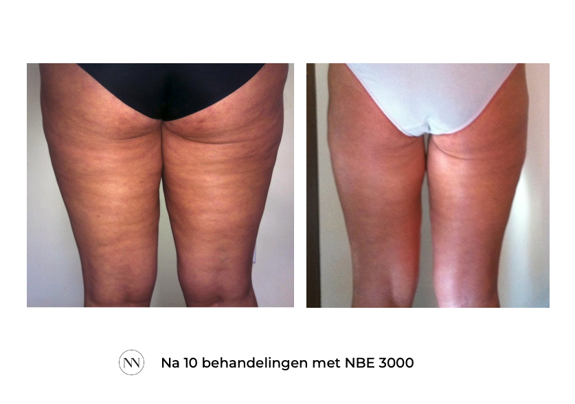 Achterwerk 10x NBE NL