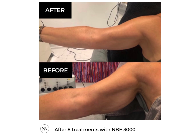 Arm 8x NBE ENG