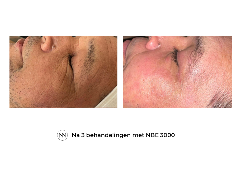Eyes 3x NBE NL