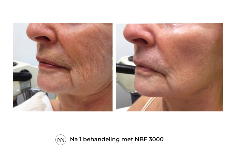 Face 1x NBE NL