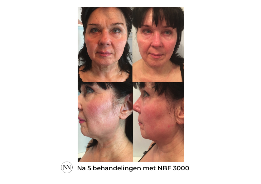 Face_2 5x NBE NL