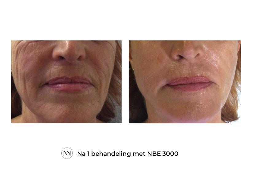 Face_3 1x NBE NL