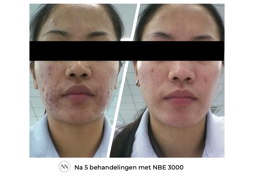 Face_3 5x NBE NL