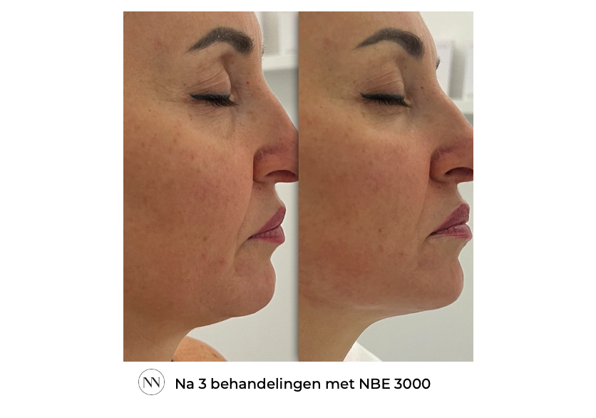 Face 3x NBE NL