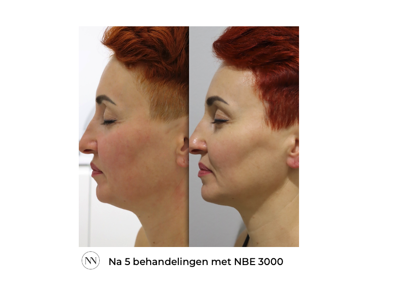 Face 5x NBE NL