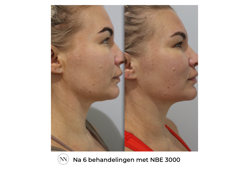 Face 6x NBE NL