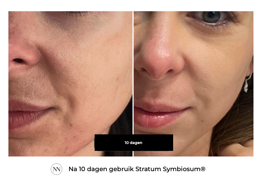 Stratum 10 dagen NL
