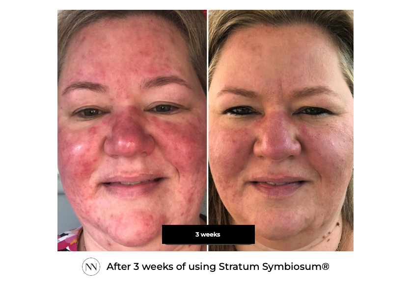 Stratum 3 weeks ENG