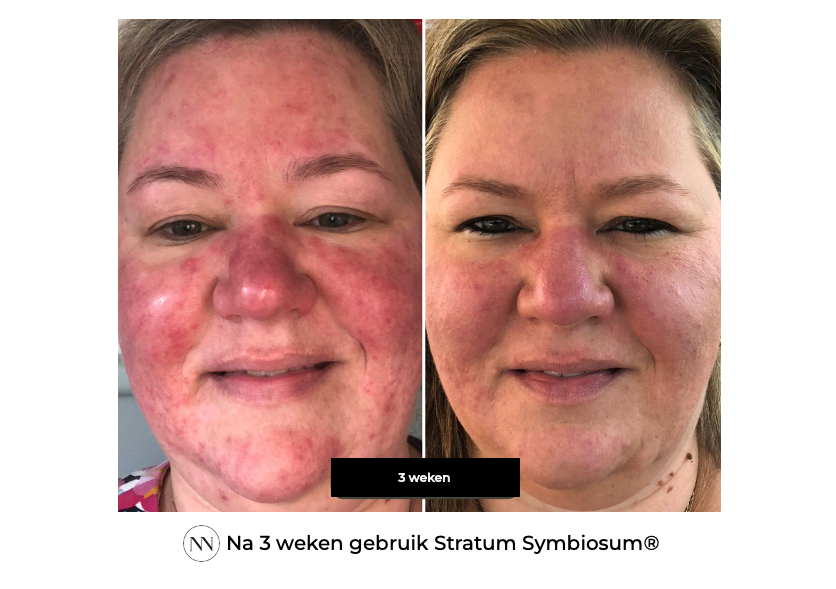 Stratum 3 weeks NL
