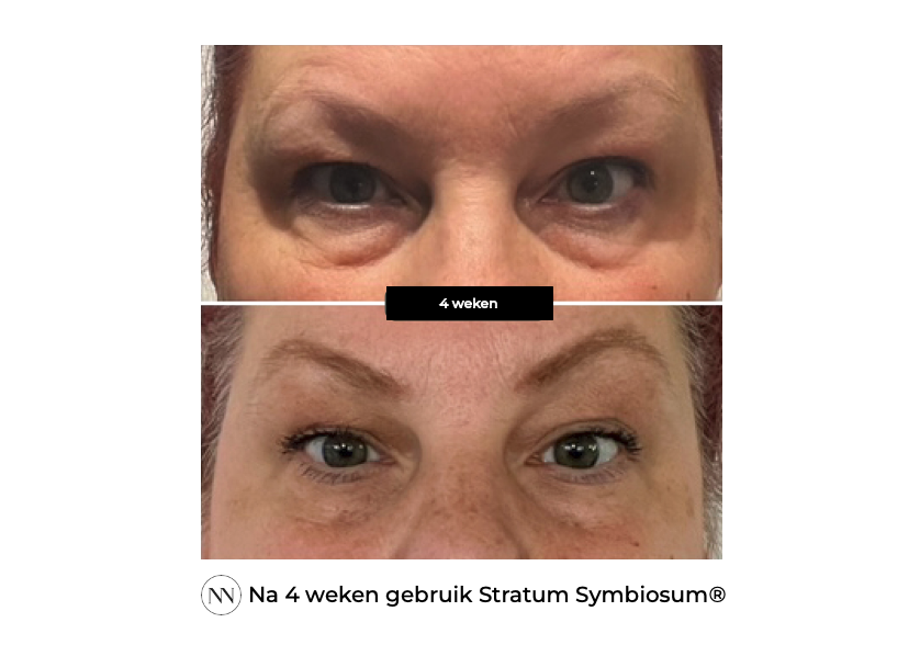 Stratum 4 weeks NL
